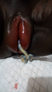 Appearance of the vulva on Prolonged Obstructed Labor with a fresh still birth