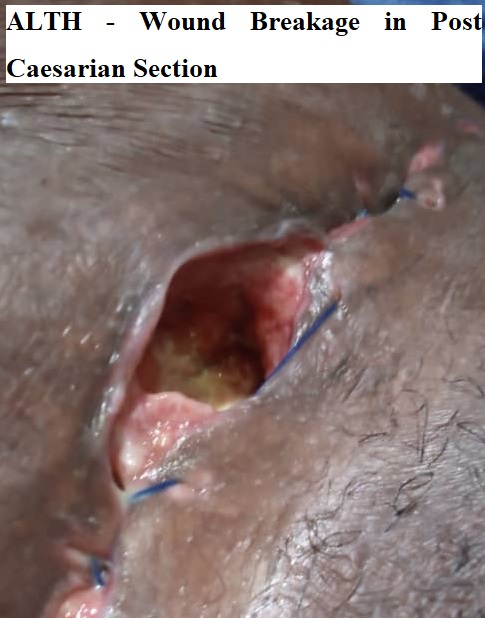 Wound Breakage in Post Caesarian Section
