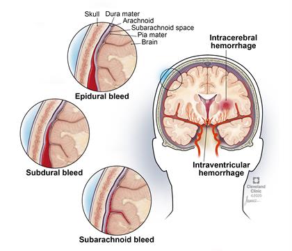 Intracranial Hemorrhage