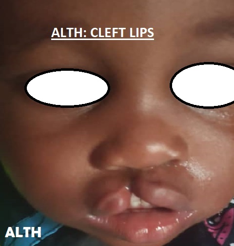 Cleft Lips: Basic Healthy Guidelines