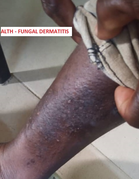Fungal dermatitis – Useful medical tips on safety