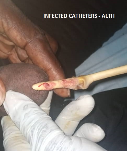 Infected In-situ Catheter – Causes, Complication and Treatment