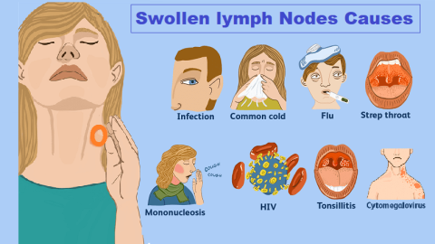 Swollen Lymph Nodes - Living Tower Medical Services