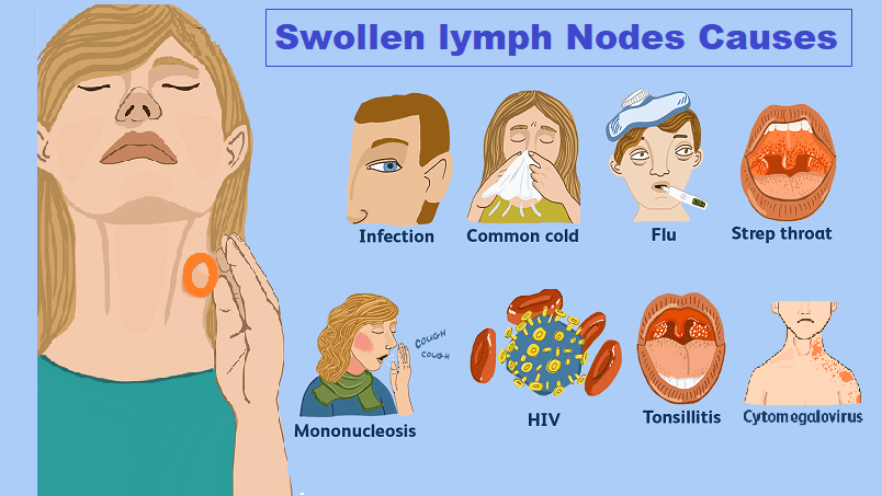 swollen supraclavicular lymph nodes following a cold