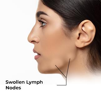 amoxicillin for swollen lymph nodes