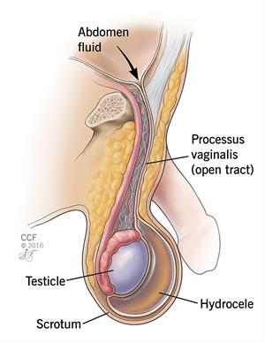 Explaining Hydroceles and How Hydrocele Underwear Helps